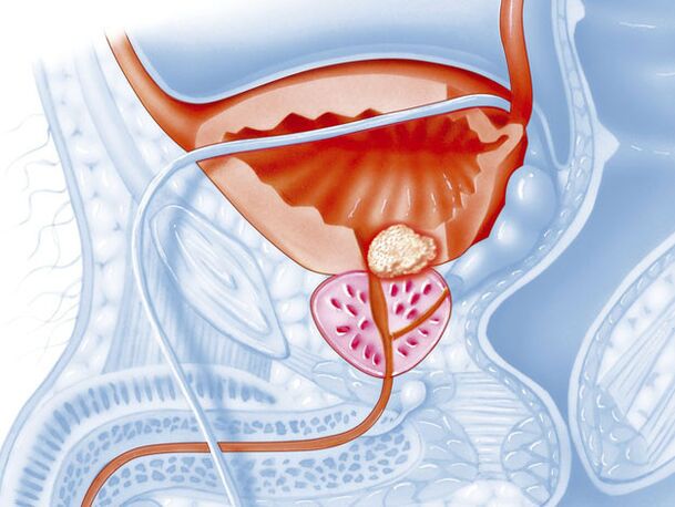 Bacterial form of prostatitis